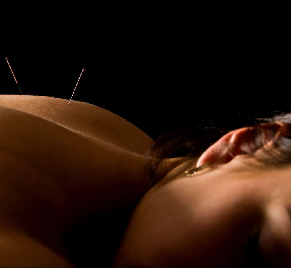 Acupuncture Woman Back Needles